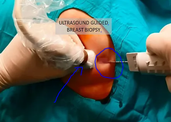 Trucut Biopsy – A novel Technique in Cancer World.
