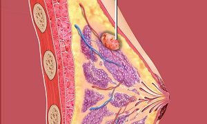 Fibroadenoma : Recent Advances on Treatment