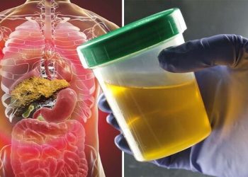 Dark urine could indicate a liver problem – Added Updates