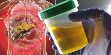 Dark urine could indicate a liver problem – Added Updates