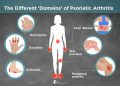 Causes of psoriatic arthritis: Triggers and risk factors recent updates
